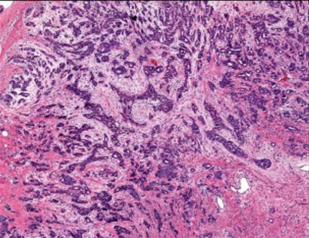 H&E histology section showing tumor immune infiltration